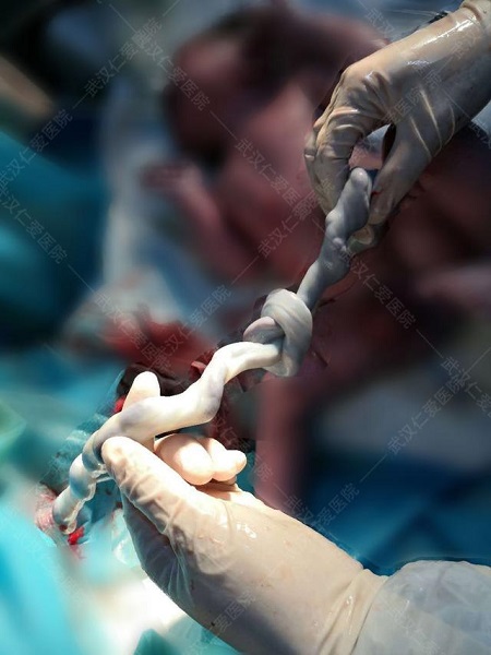 胎兒太調(diào)皮，竟在媽媽肚子里面將臍帶打了個(gè)結(jié)！