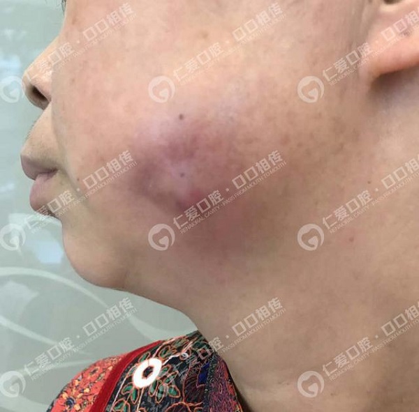 驚!女子智齒反復發(fā)炎未在意,臉頰被膿腫穿破