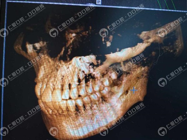 驚!女子智齒反復發(fā)炎未在意,臉頰被膿腫穿破