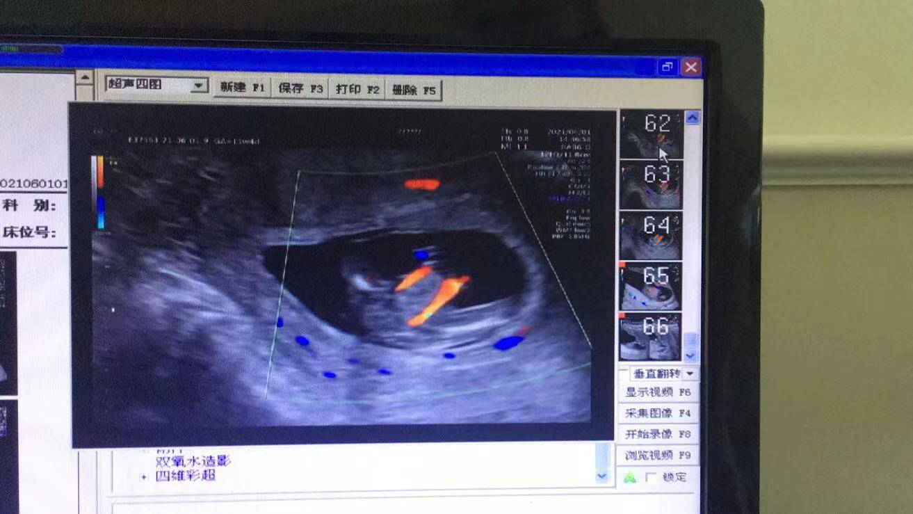 NT篩查出胎兒多發(fā)畸形，準(zhǔn)媽媽無奈終止妊娠